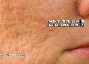 Balın Sivilce İzlerine Faydaları Nelerdir?