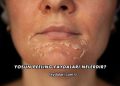 Yosun Peeling Faydaları Nelerdir?