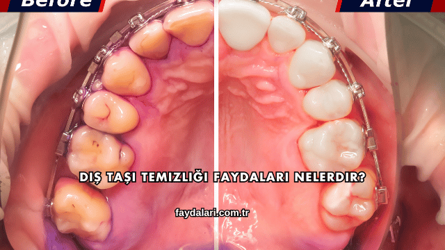 Diş Taşı Temizliği Faydaları Nelerdir?