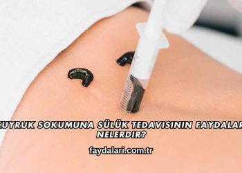 Kuyruk Sokumuna Sülük Tedavisinin Faydaları Nelerdir?