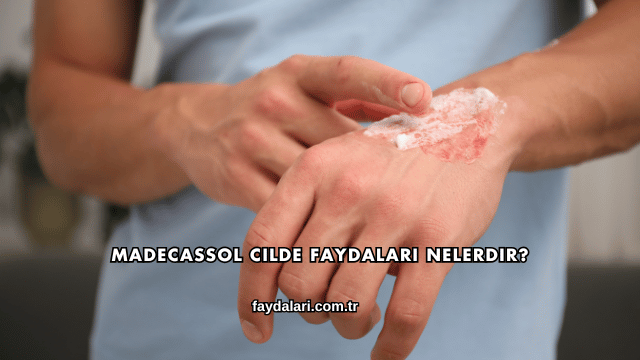 Madecassol Cilde Faydaları Nelerdir?