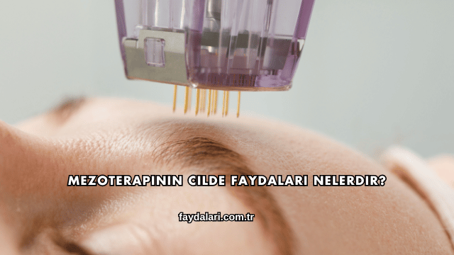 Mezoterapinin Cilde Faydaları Nelerdir?