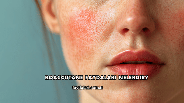 Roaccutane Faydaları Nelerdir?