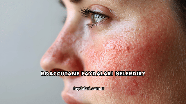 Roaccutane Faydaları Nelerdir?